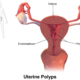 Uterine polyps